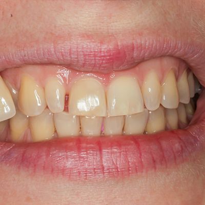 Teeth Whitening - Smile 5 before